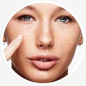 Behandlung von Pigmentflecken