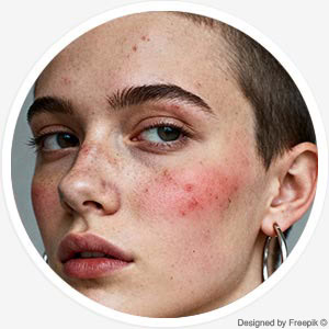 Rosazea- und Sensitive-Haut-Behandlung Rosazea- und Sensitive-Haut-Behandlung